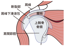 腱板断裂