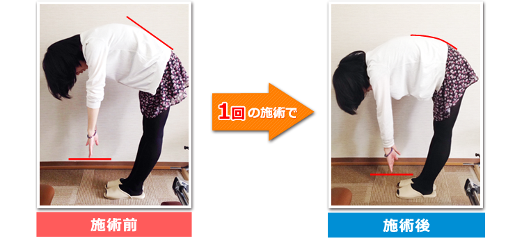 1回の施術で
