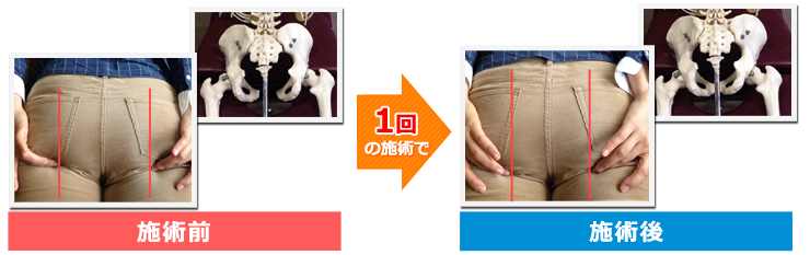 1回の施術で
