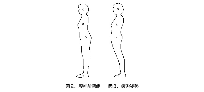 腰椎前湾症/疲労姿勢